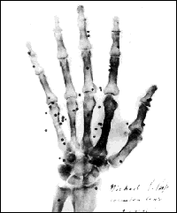 Xray of Hand